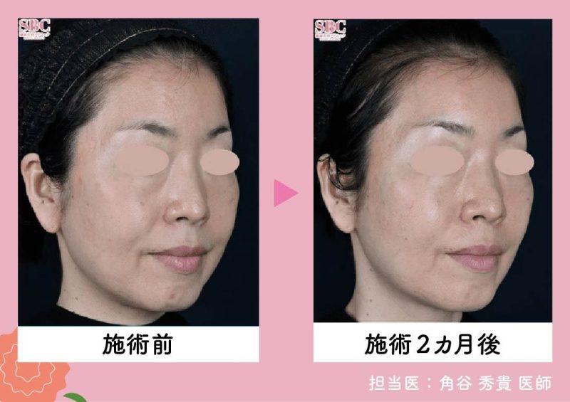 デンシティ（DENSITY）<br />
〜最新のRF（高周波）で肌密度をギュギュッとアップ！〜 