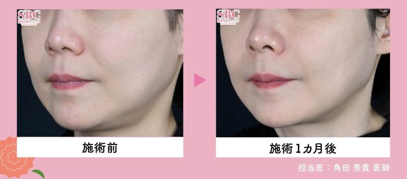 ウルセラプライム<br />
〜「切らないリフトアップ」の定番！〜 