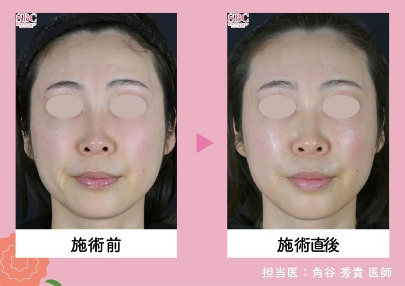 ソフウェーブ（Sofwave）<br />
〜目元や首のシワまで！究極のタイトニング〜 