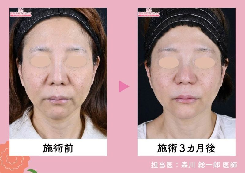 プロファイロ（PROFHILO）<br />
〜細胞を呼び覚ます！次世代の美肌注射〜 