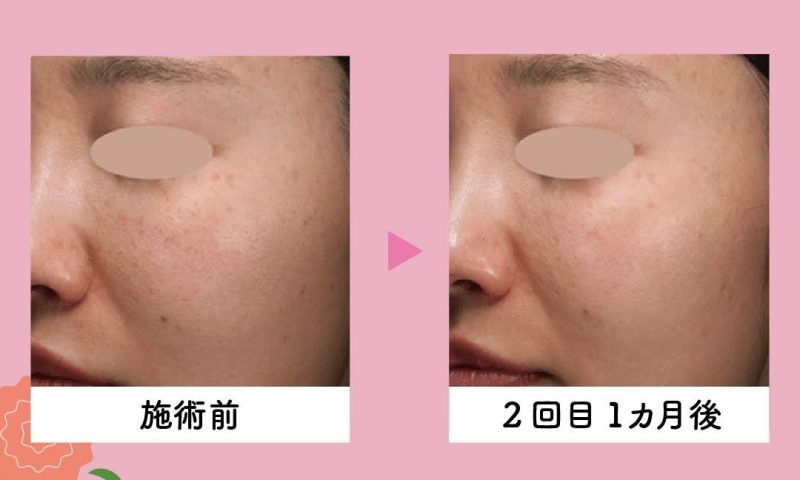 ルビーフラクショナル<br />
〜諦めていたそのしみに！広範囲アプローチ〜 