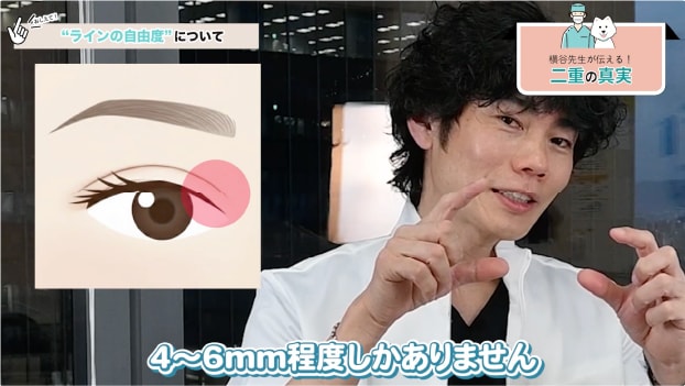 瞼板法で「幅の広い二重」が取れやすい理由
