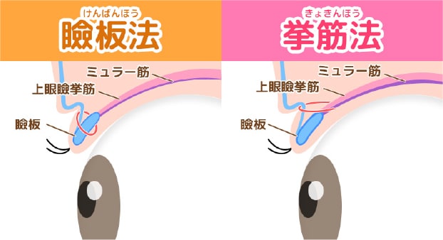 そもそも『挙筋法』と『瞼板法』って何が違う？