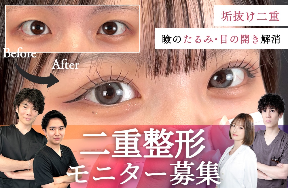 二重のプロフェッショナルドクター達による★二重モニター募集