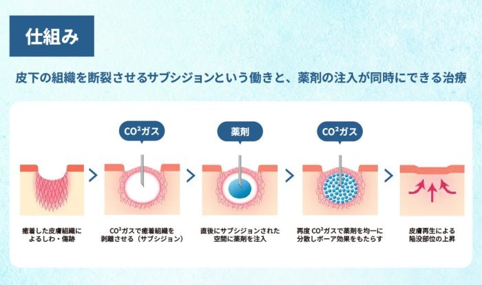 「炭酸ガス」×「薬剤」のWアプローチ！