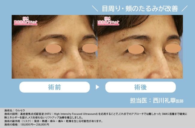 ウルセラ症例②