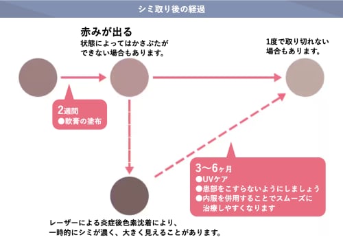 シミ取りレーザーのダウンタイム期間や注意点