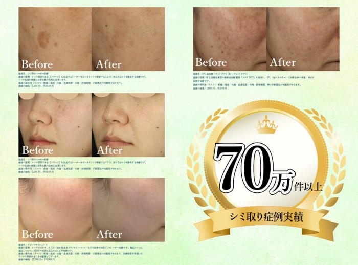 ①70万件超えのシミ取り症例実績