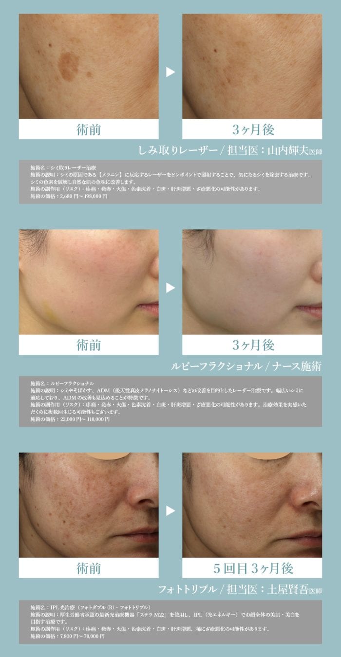 シミ取りで憧れの透明肌へ