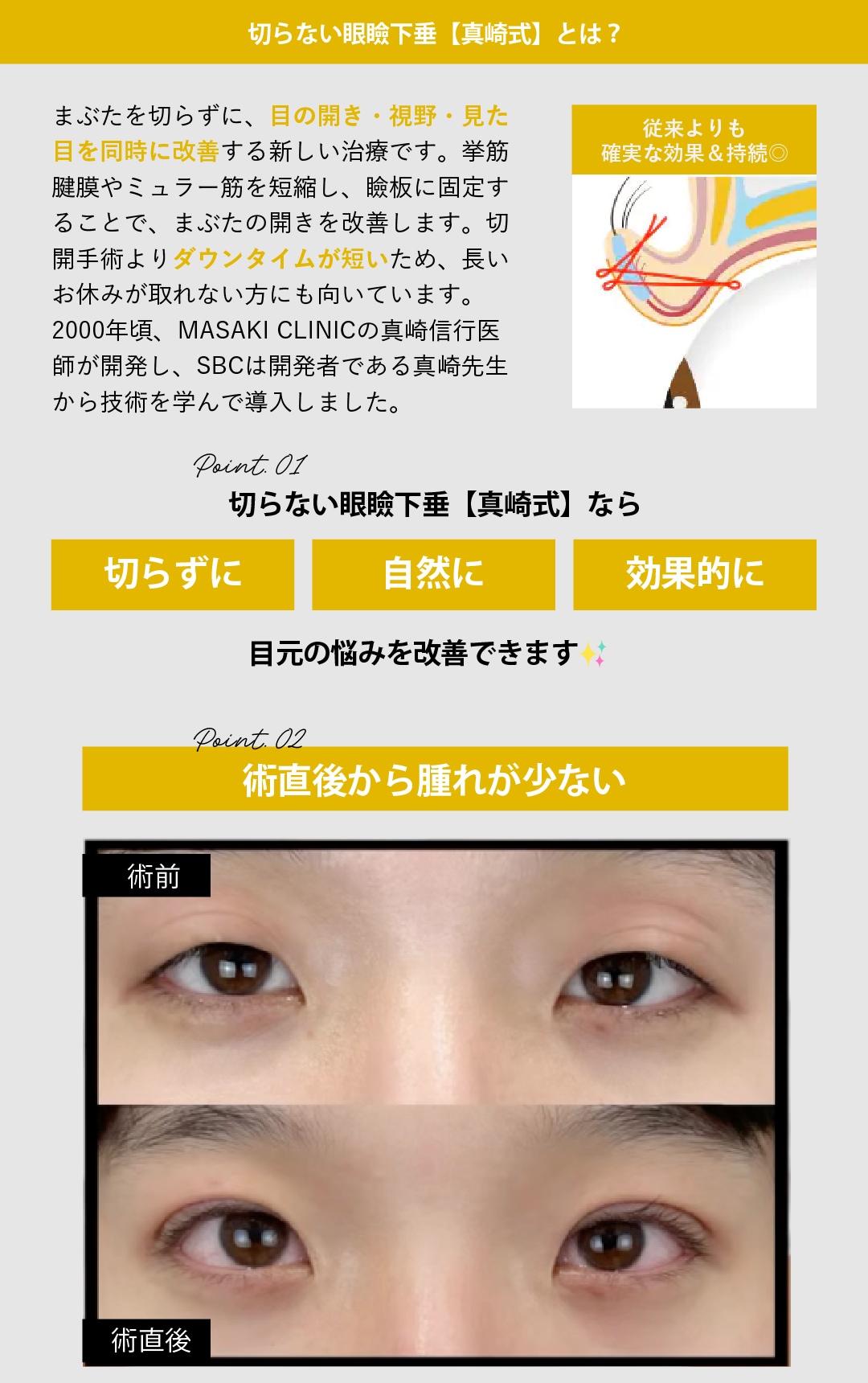 切らない眼瞼下垂