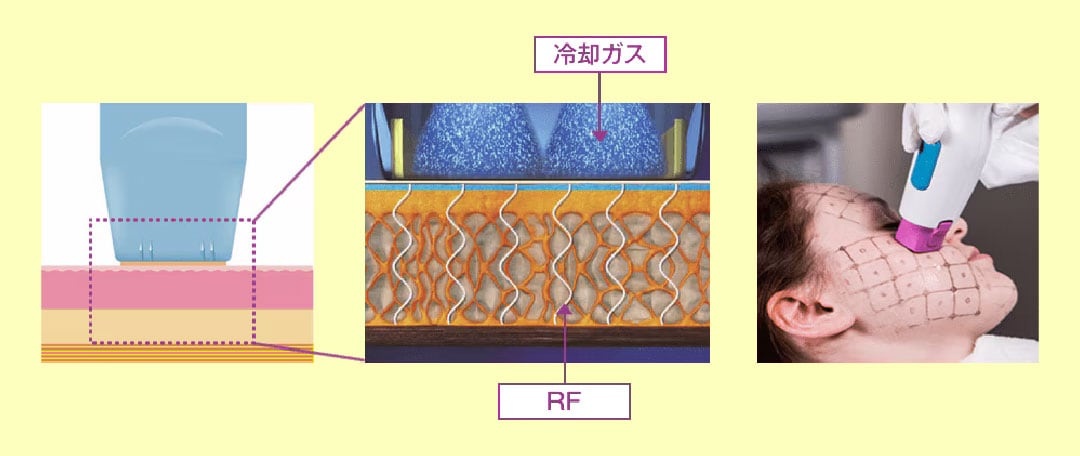 お肌のたるみやシワを改善する高周波（RF）たるみ治療器✨