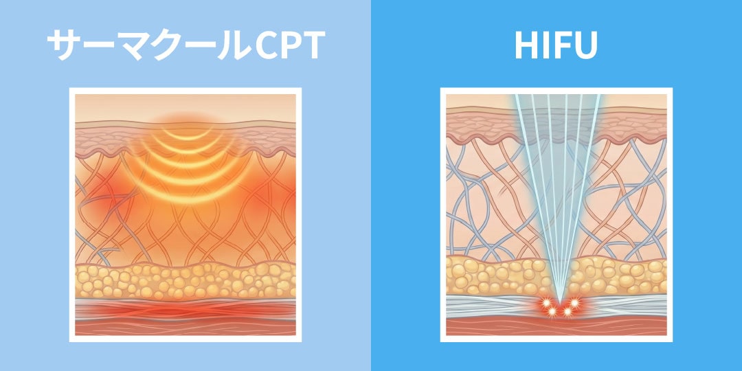 HIFU（ハイフ）との違いは？