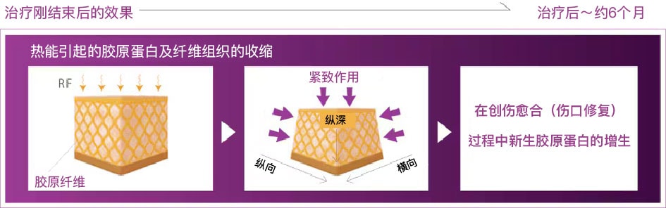 亮点② 长期性的胶原蛋白新生与重构