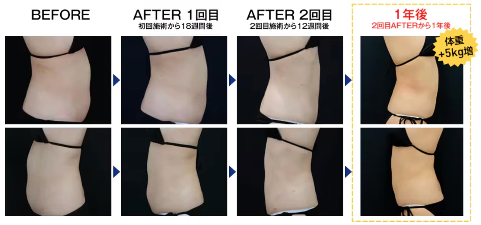 【クールスカルプティング® エリート（クルスカダブル）】の効果は？