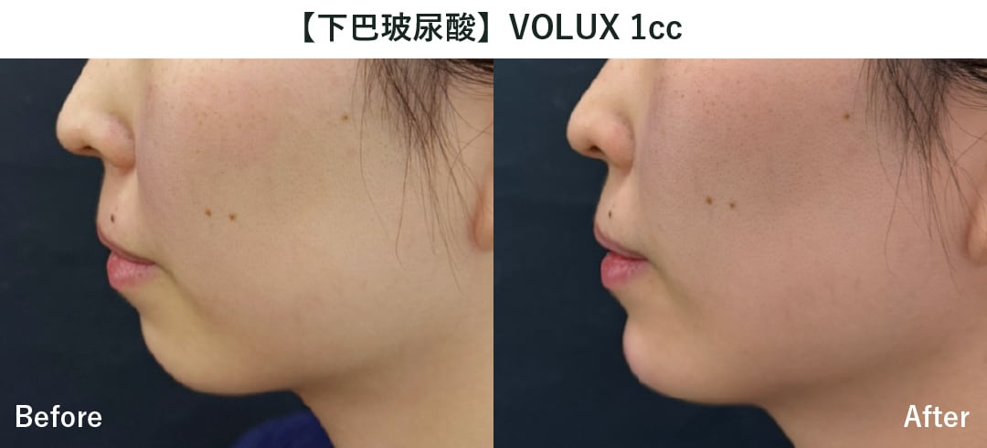 【丰下巴/下巴玻尿酸】乔雅登Volux 1cc