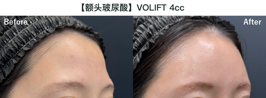 【额头玻尿酸/丰额头】乔雅登Volift 4cc