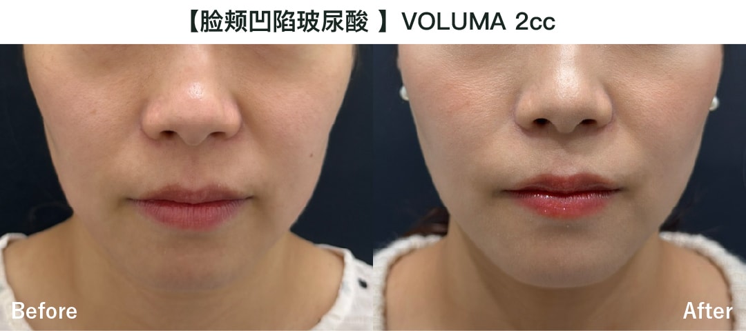 【面颊凹陷/丰面颊】乔雅登Voluma 2cc