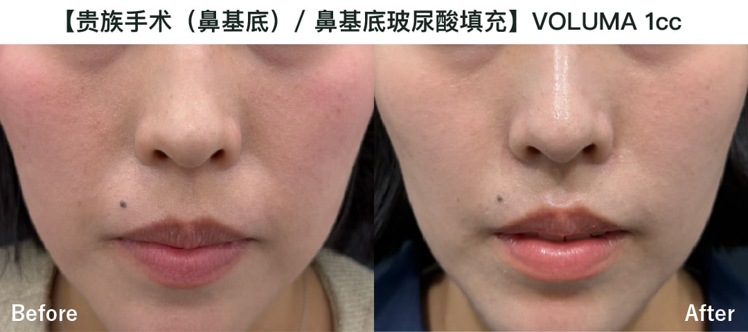 【贵族手术（鼻基底）/ 鼻基底玻尿酸填充】乔雅登Voluma 1cc
