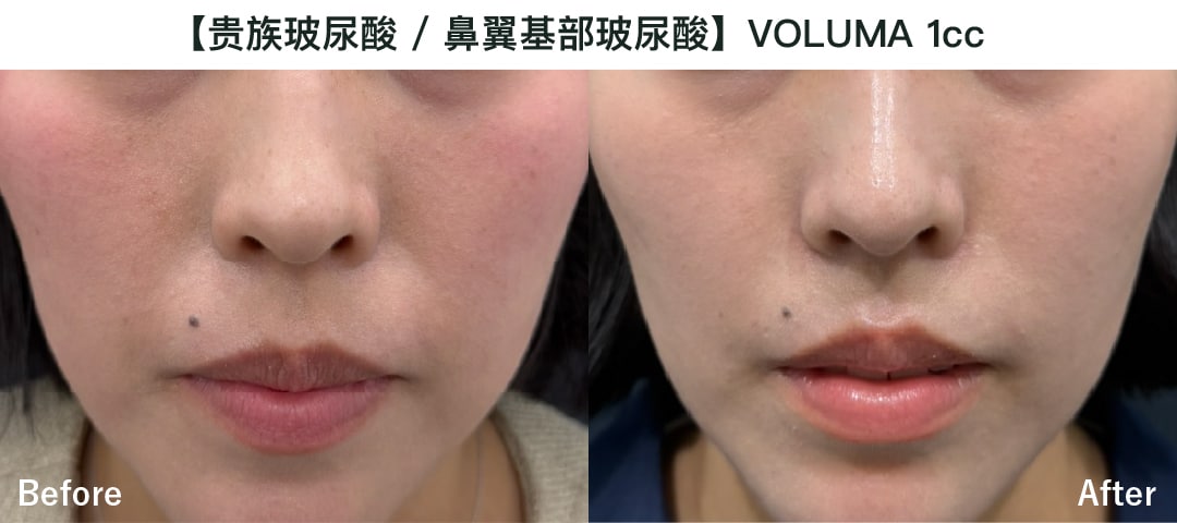 【贵族手术（鼻翼基部）/ 鼻翼基部玻尿酸】乔雅登Voluma 1cc