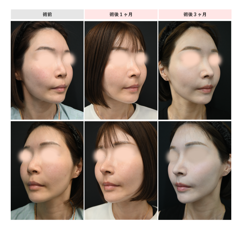 お客様一人一人の顔に馴染む違和感のない忘れ鼻をつくります。