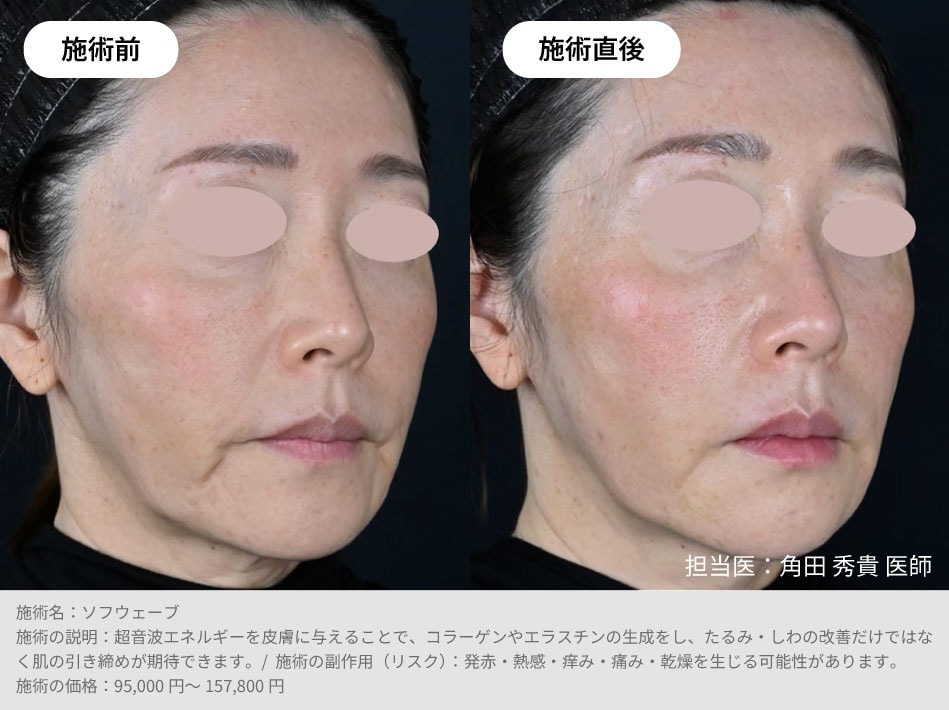 痩せ型・頬コケが気になる方にも◎