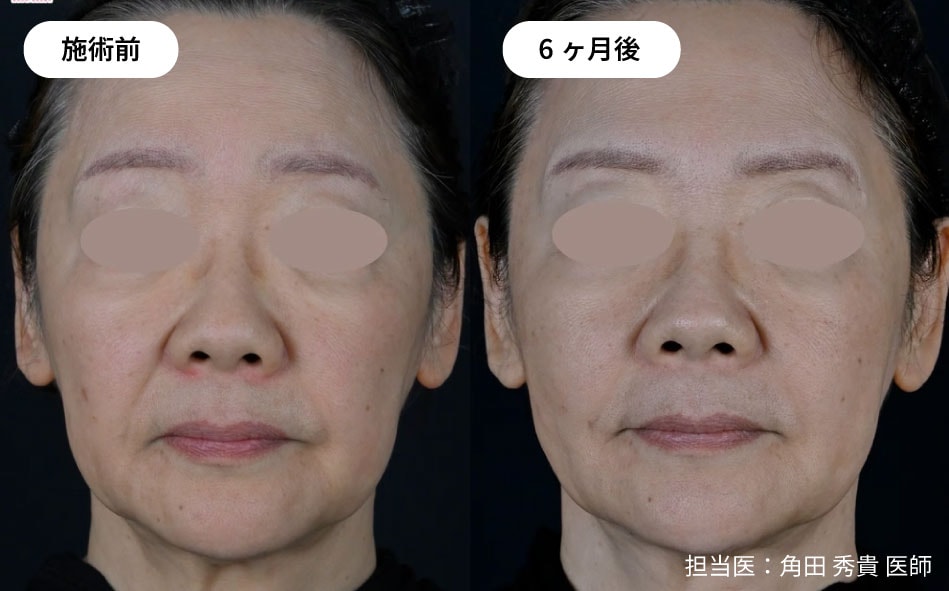 ほうれい線が改善