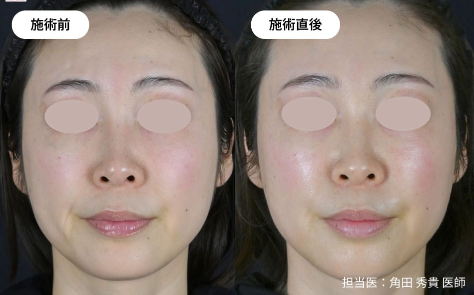 直後からお肌を引き締め効果を実感！