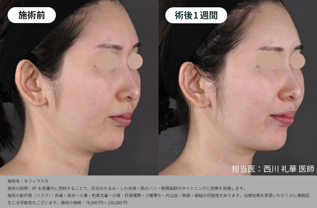 皮膚・脂肪のタイトニング治療