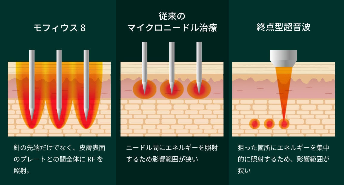 「脂肪縮小」と「引き締め」を同時に達成