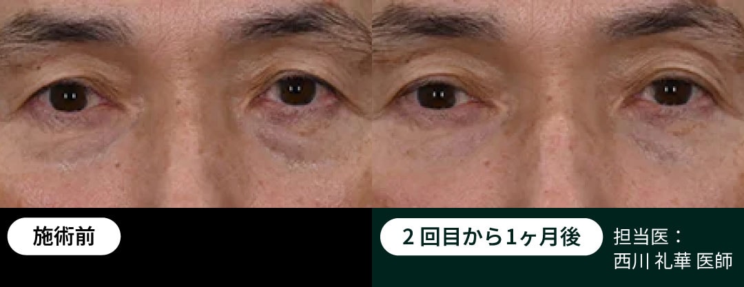 目の下のぷっくり脂肪がスッキリ！