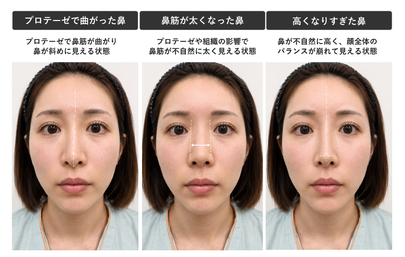 鼻整形は「安さ」を重視すると失敗するので「クリニック」ではなく「医師」で選びましょう。