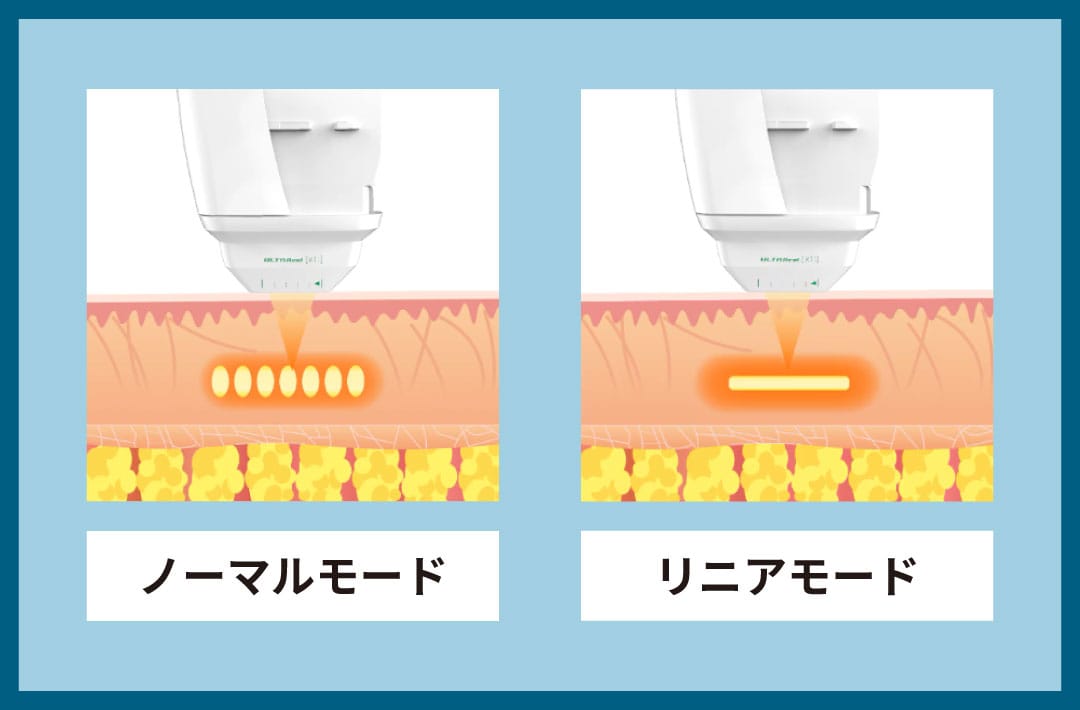 「点（ノーマル）」と「線（リニア）」のW照射モードで立体アプローチ