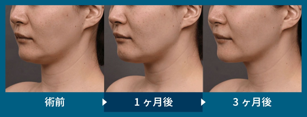 フェイスラインがくっきり！首のしわも薄くなりました！