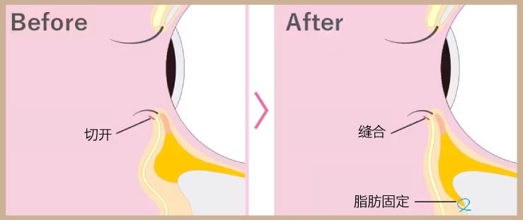 外切Hamra：想一同改善眼下松弛的人