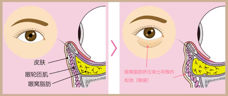 去脂：僅在意眼下突出