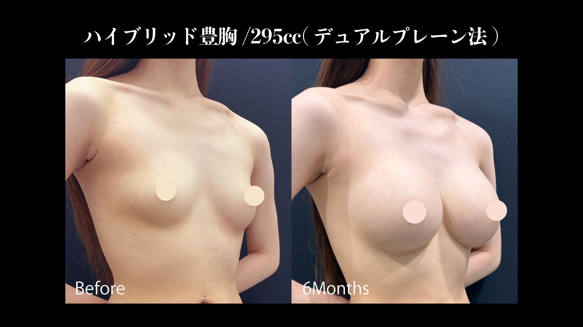 ハイブリッド豊胸