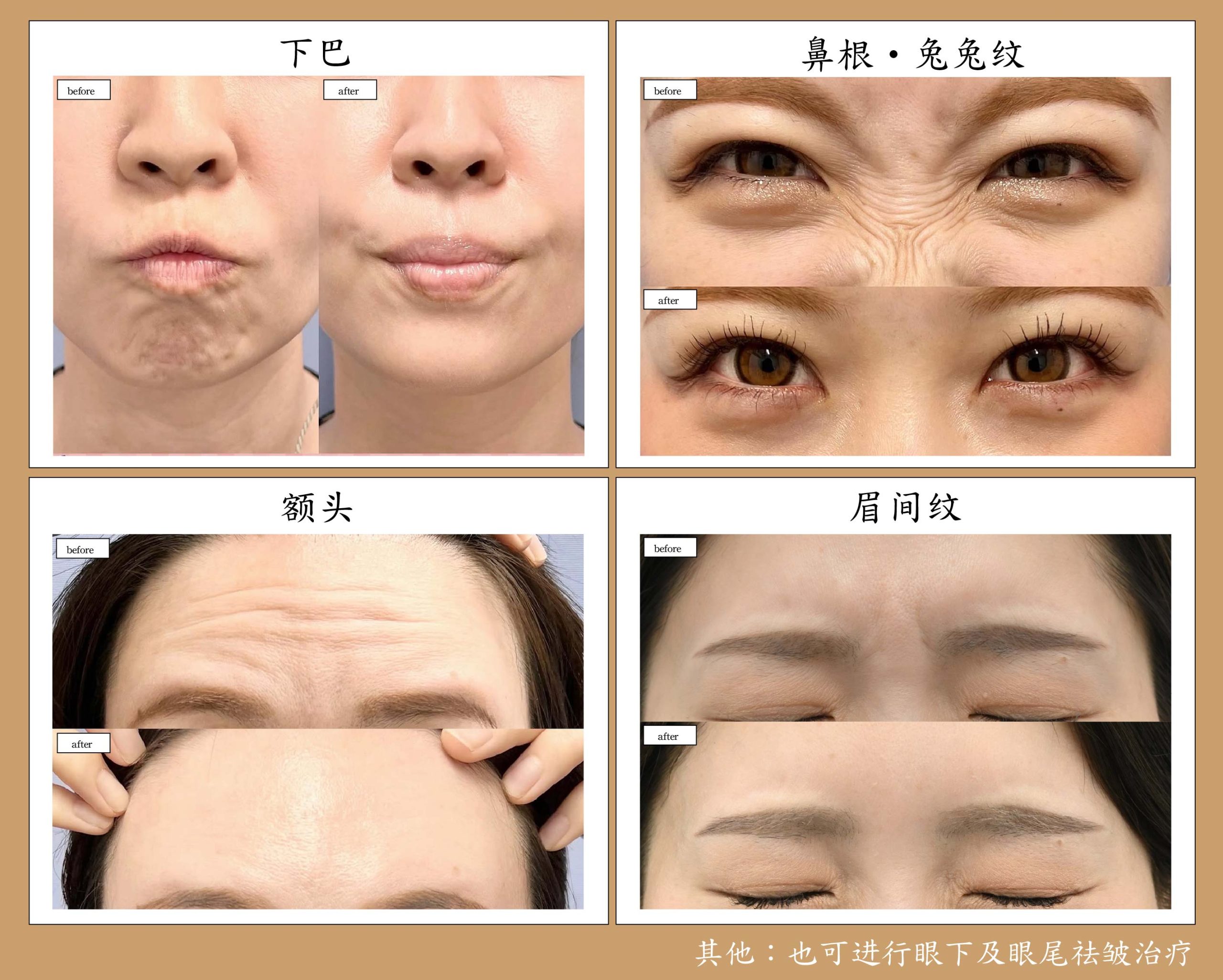 ① 肉毒素（Botox）