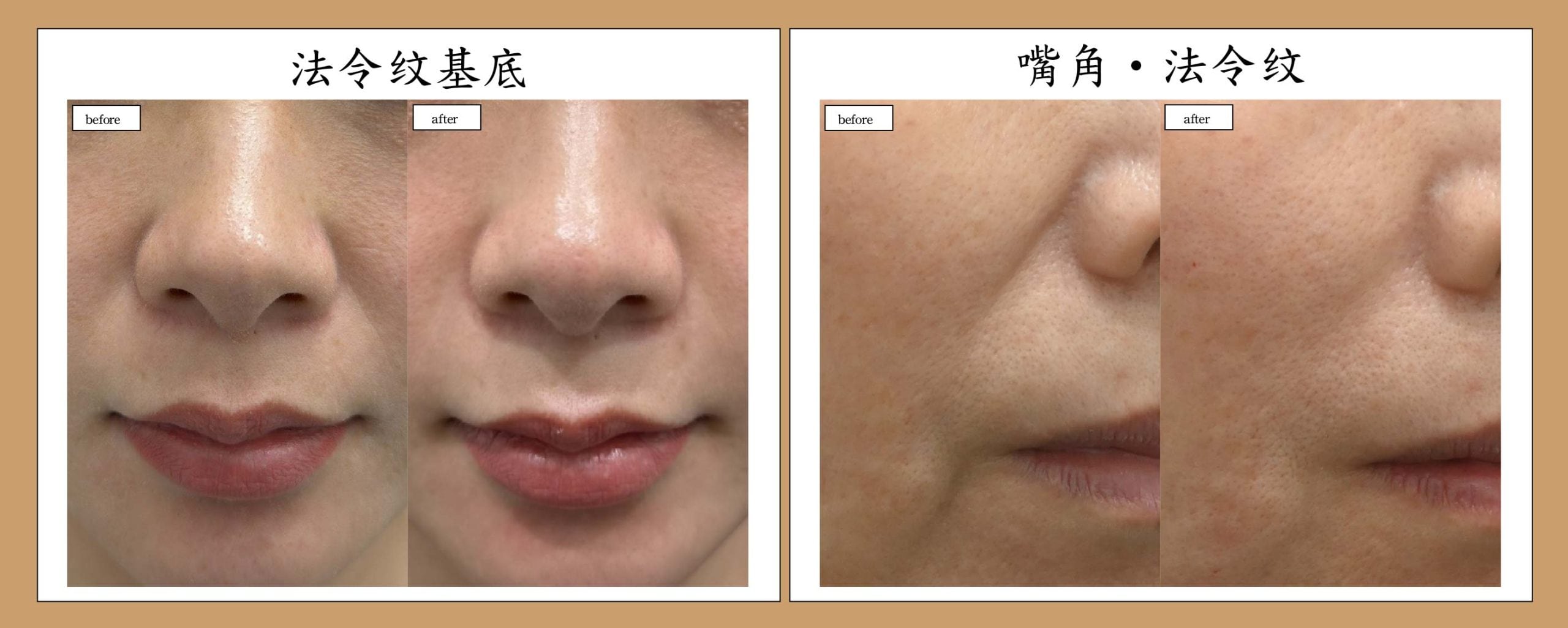② 玻尿酸（Hyaluronic Acid）
