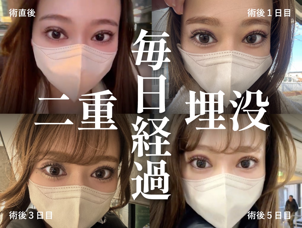 【症例有り】埋没ダウンタイム術後1週間までの腫れ・内出血を大公開｜腫れが強く出たケースのリアル経過レポ