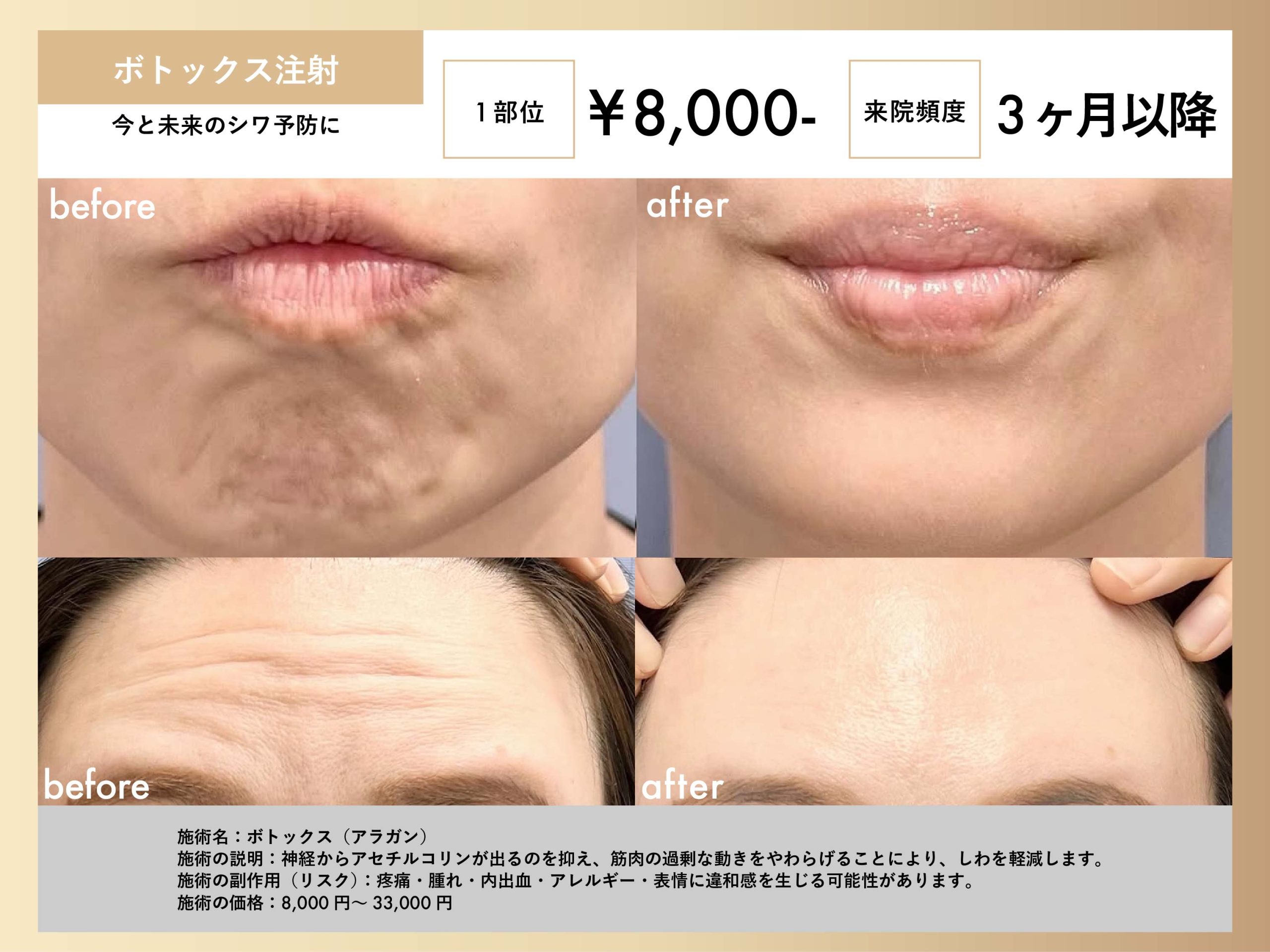 しわ取り