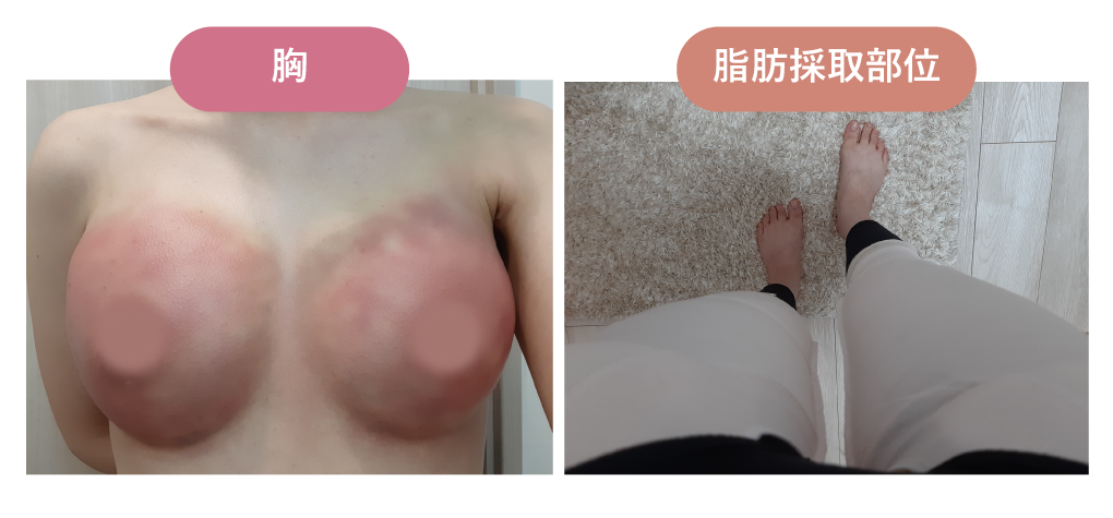 術後1日目｜手術から1日経過した様子