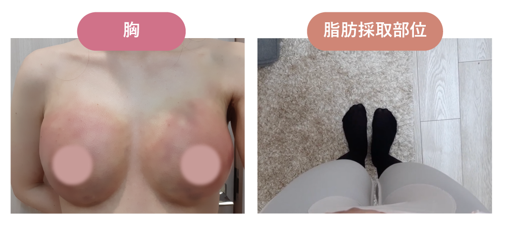 術後2日目｜クリニックの来院日
