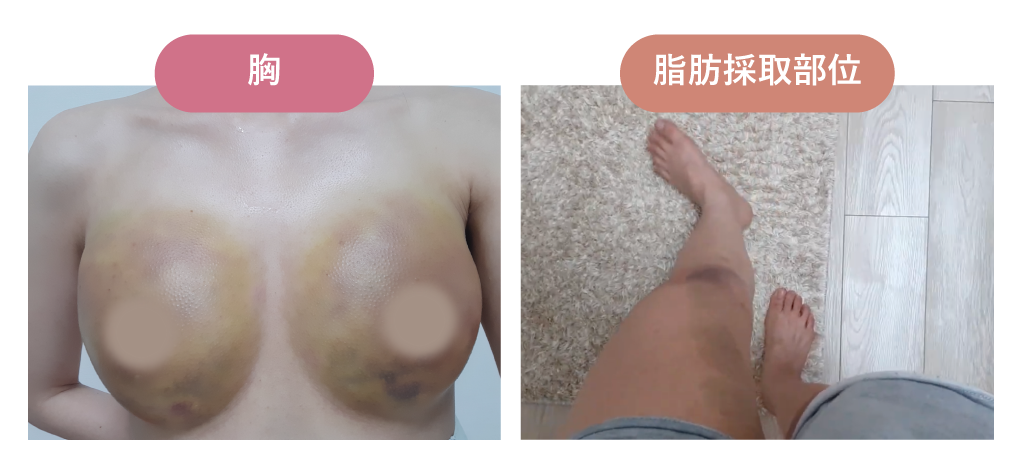 術後3日目｜症状の変化と過ごし方
