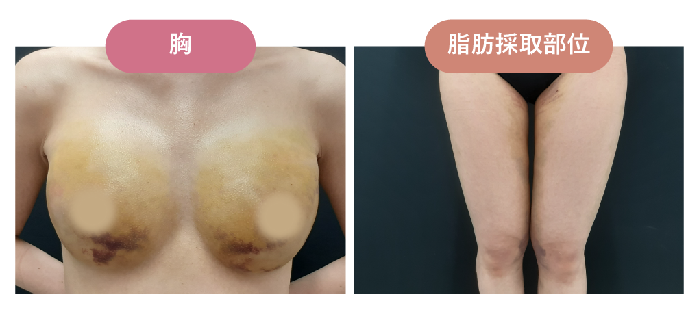 術後6日目｜クリニック来院日