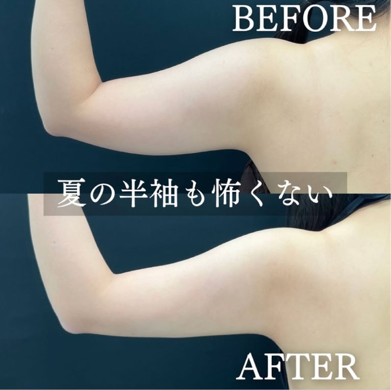 脂肪吸引：二の腕<br />

