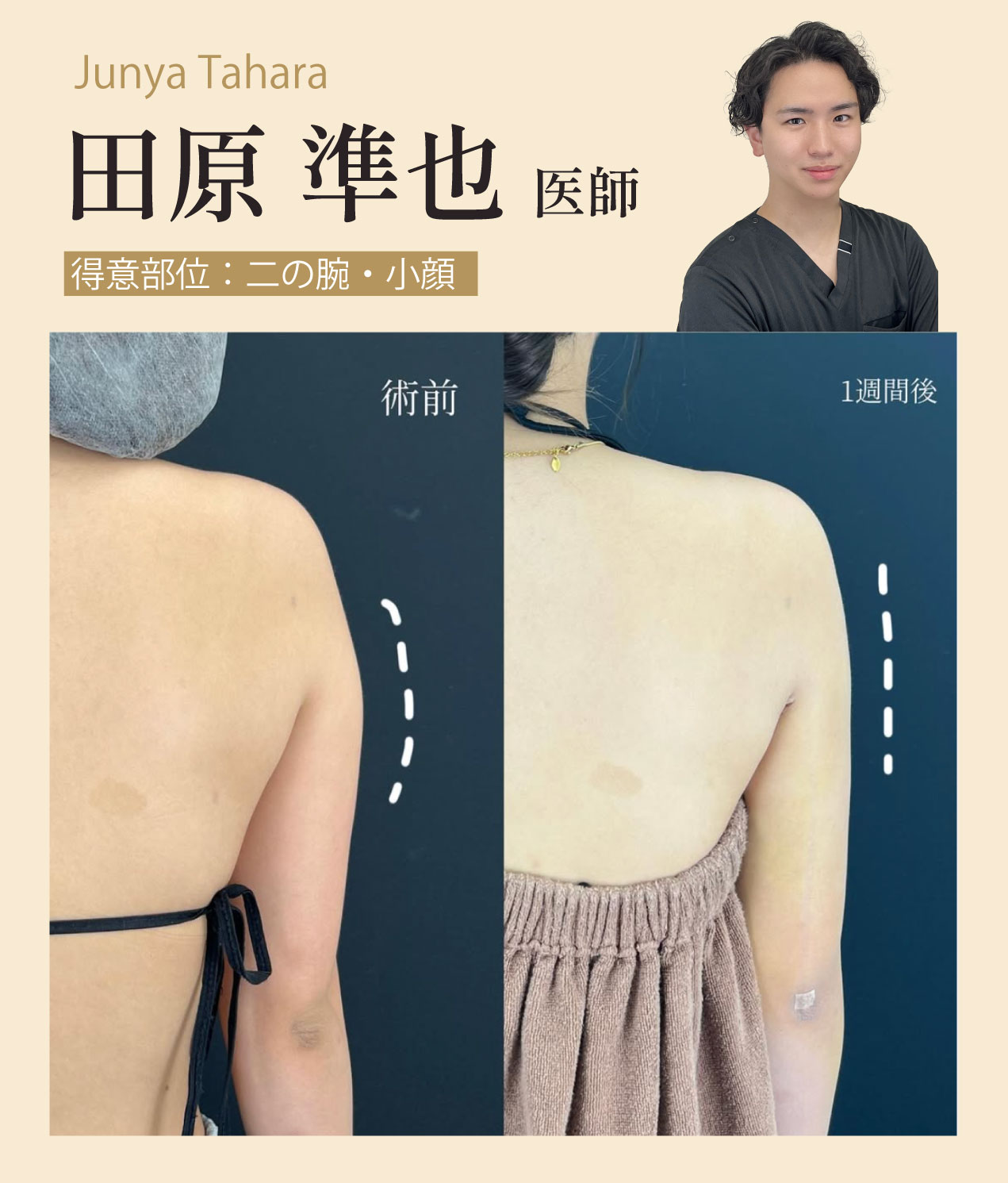 院長経験を有する実力派医師！二の腕の脂肪吸引なら田原医師 へ<br />
