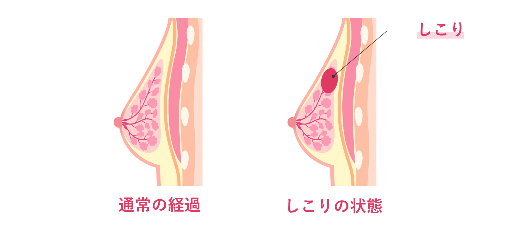 しこり・脂肪壊死・感染など