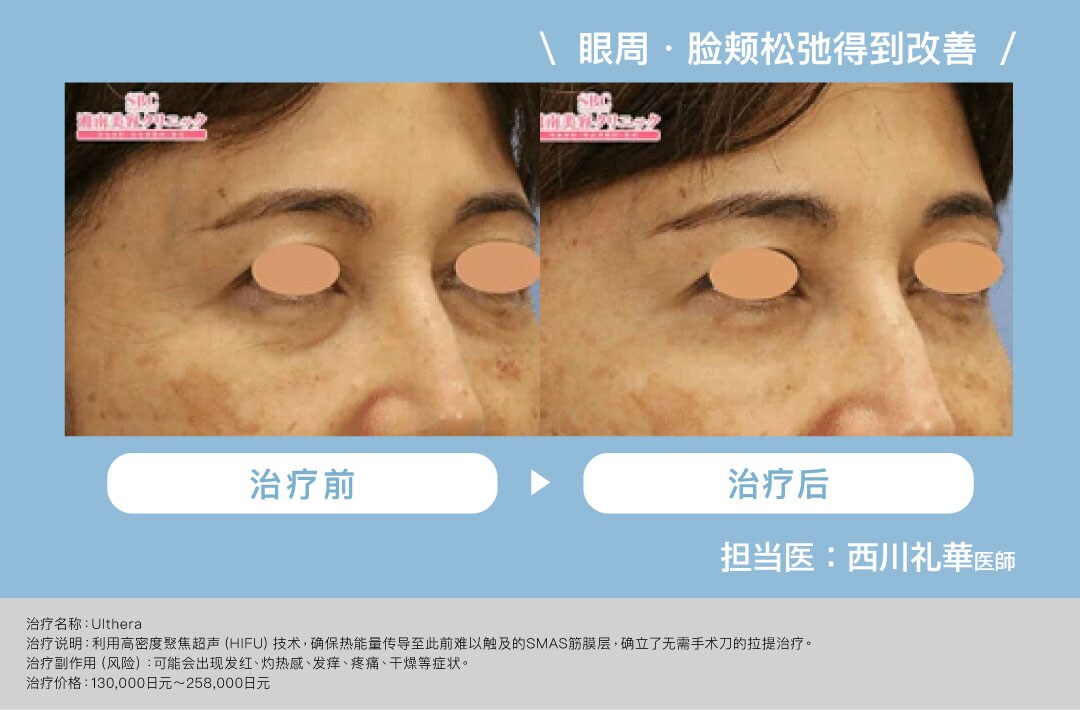 Ulthera案例②