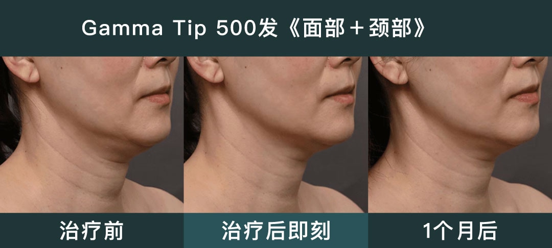 SBC独家 Gamma Tip（伽马探头）