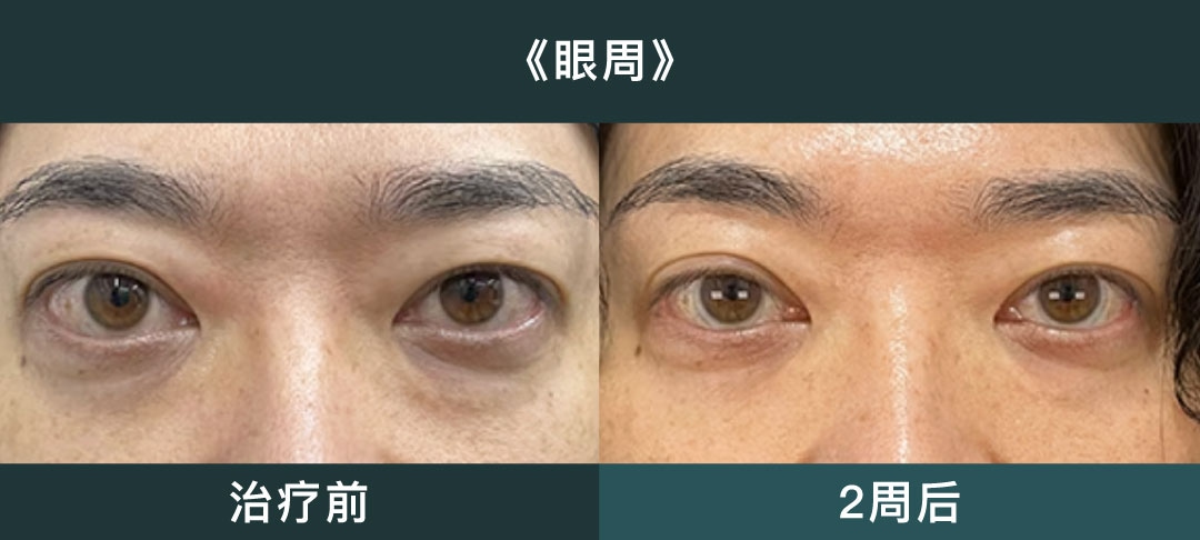 眼周及颈部也可照射